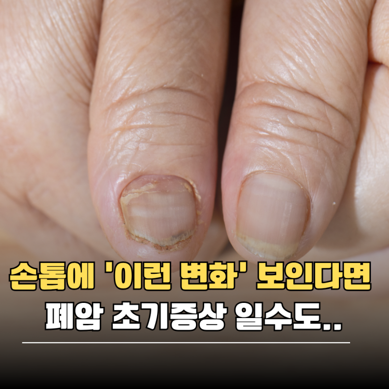 손톱에 '이런 변화' 보인다면 폐암 초기증상 일수도..
