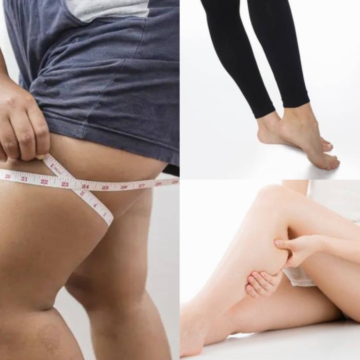  붓기 빼는 법 효과 있을까? 압박스타킹, 종아리밴드 효과