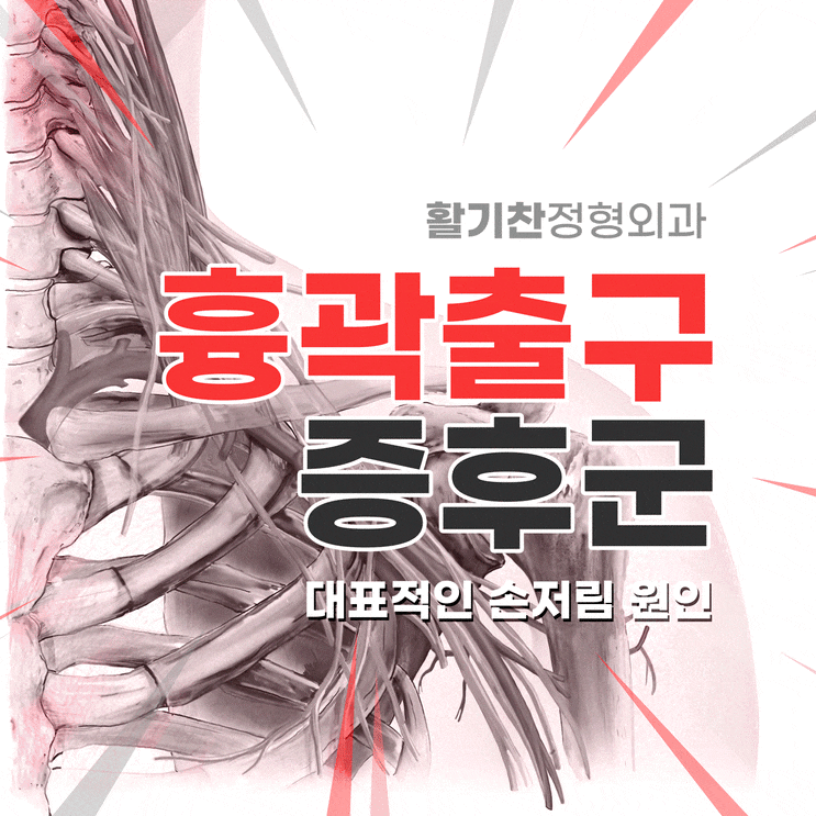  연신내통증의학과, 팔 저림의 진짜 원인, 흉곽출구증후군
