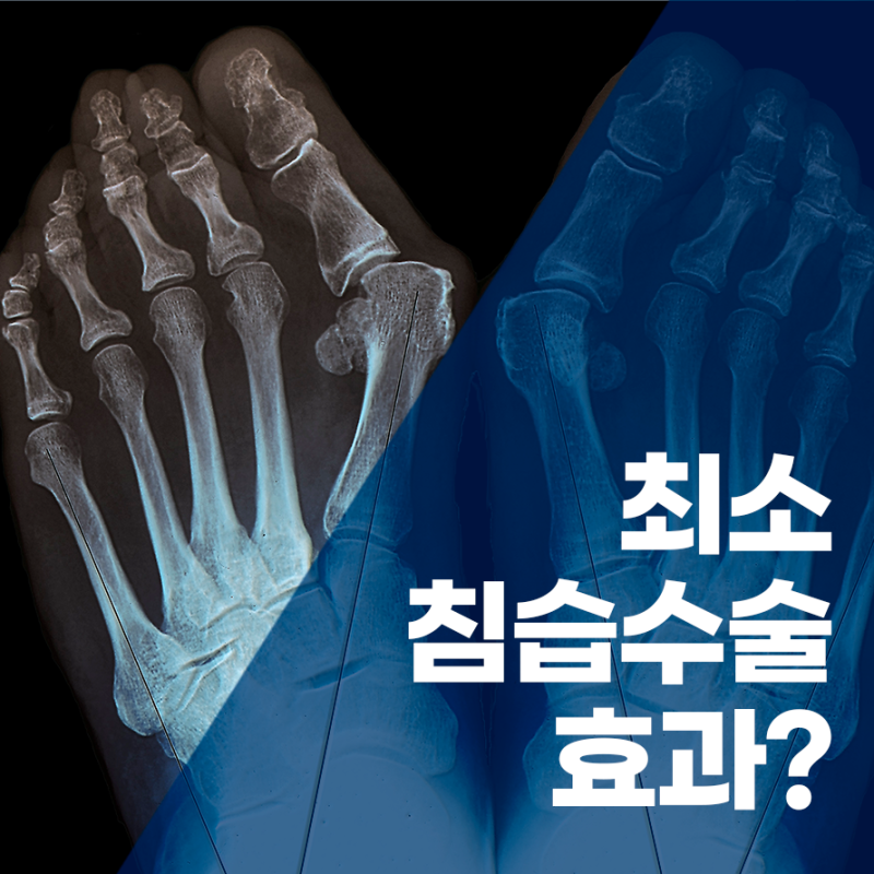 인천무지외반증 최소침습수술, 실제로 효과 있을까?(전문의 견해)