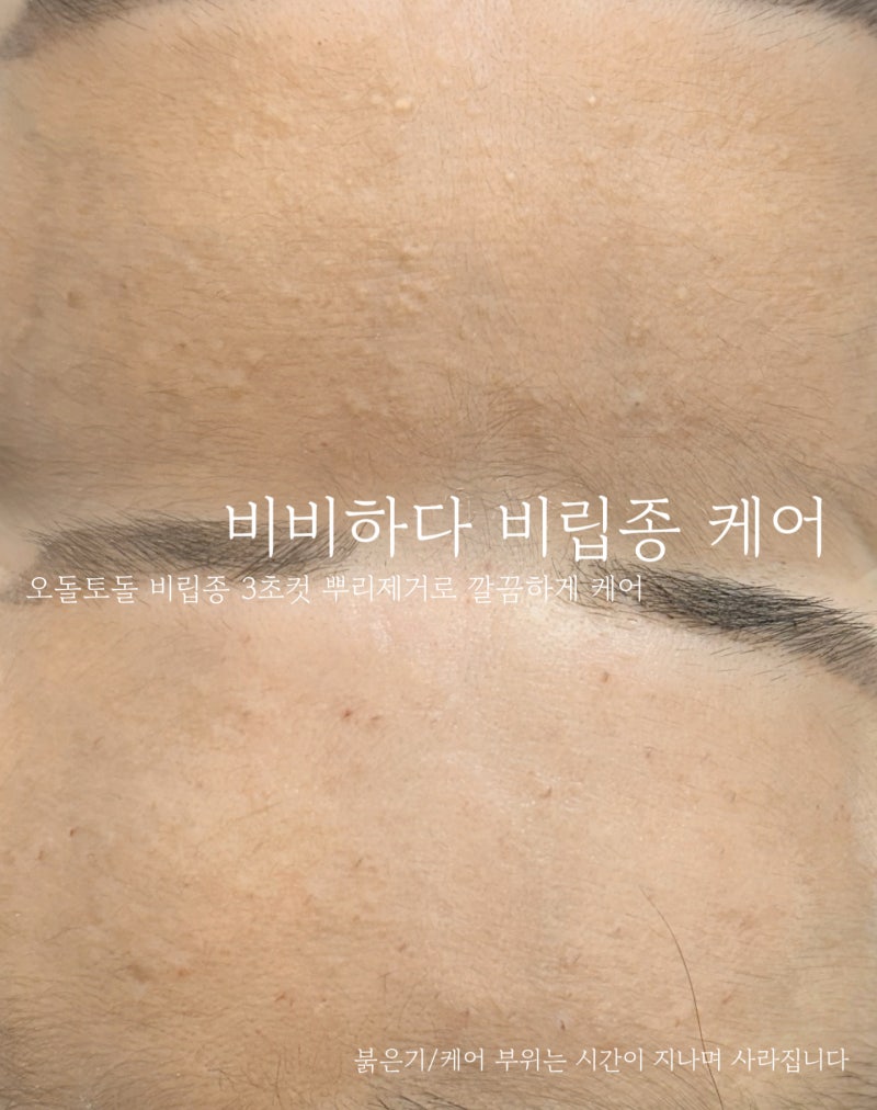 김포 비립종 케어 3초 컷 뿌리 제거로 재발률 최소화 찐 후기 추천