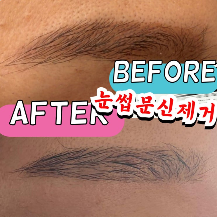  대전 눈썹문신 제거 잘하는곳 내돈내산 1회차 남자 후기 : 가격 (광고x)