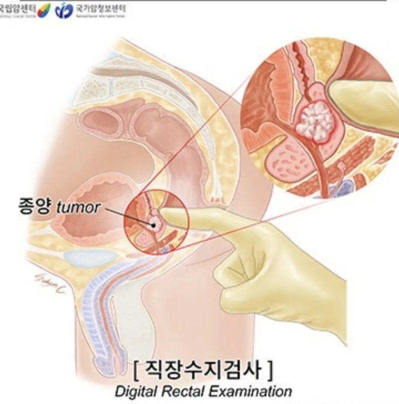 6. 분당서울대병원 전립선암 진료 후기 — 로봇수술 상담과 수술 비용 이야기
