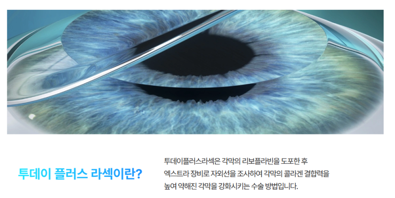 시력교정술 총정리