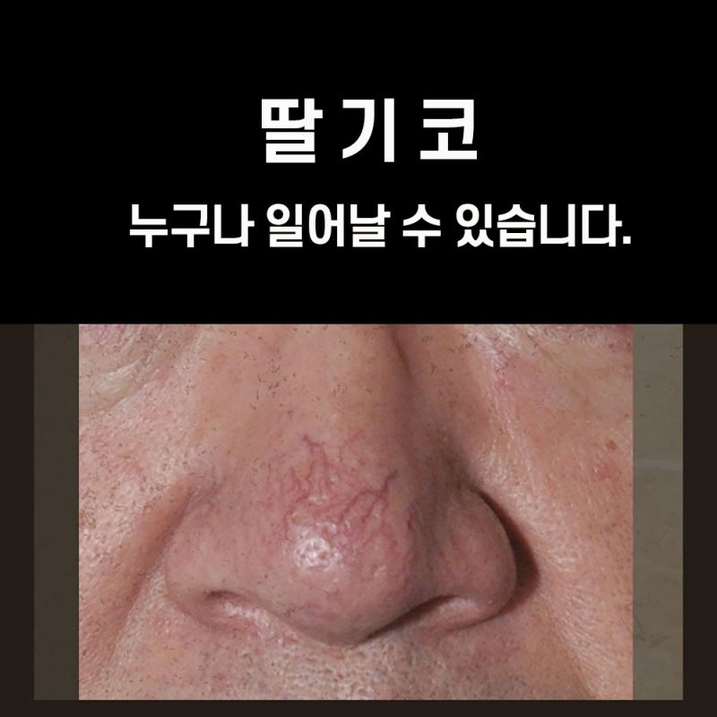 딸기코 치료 비용/가격 홍조레이저로 원인을 제거해야