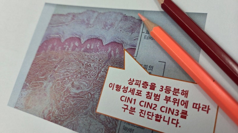 CIN1, 자연치유 가능한 이유 암이 될 가능성은?