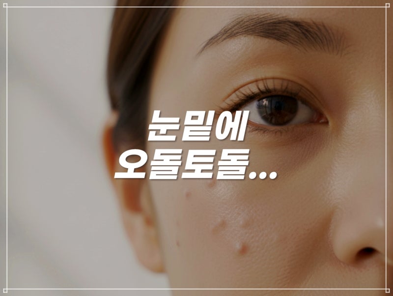 눈밑 편평사마귀 원인, 혼동되는 다른 병변은?