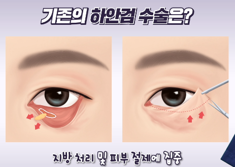 ⚕️눈밑성형의 대가 Dr.최홍림이 알려주는 ❗중년 눈밑 수술 전 꼭! 알아야 할 것들 #하안검 ....