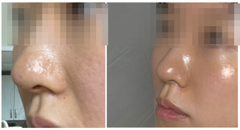 예민한 피부 추천!가성비 좋은 스킨보톡스 2회 경험담 [경기광주 경안동 피부과]