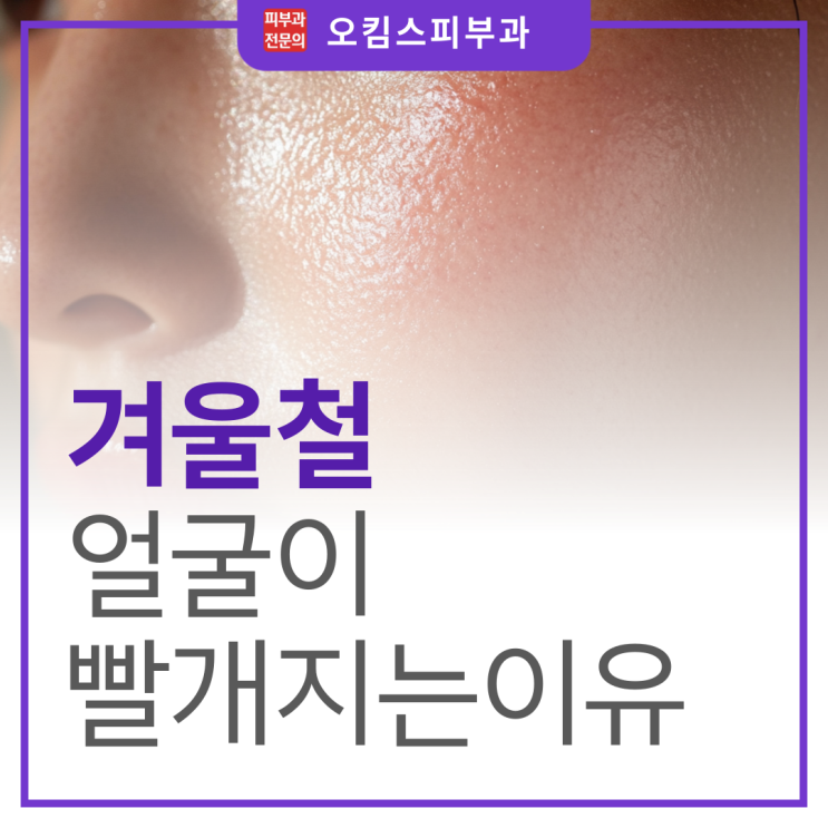  마두역 7번출구 피부과 겨울에 얼굴이 빨개지는 이유?