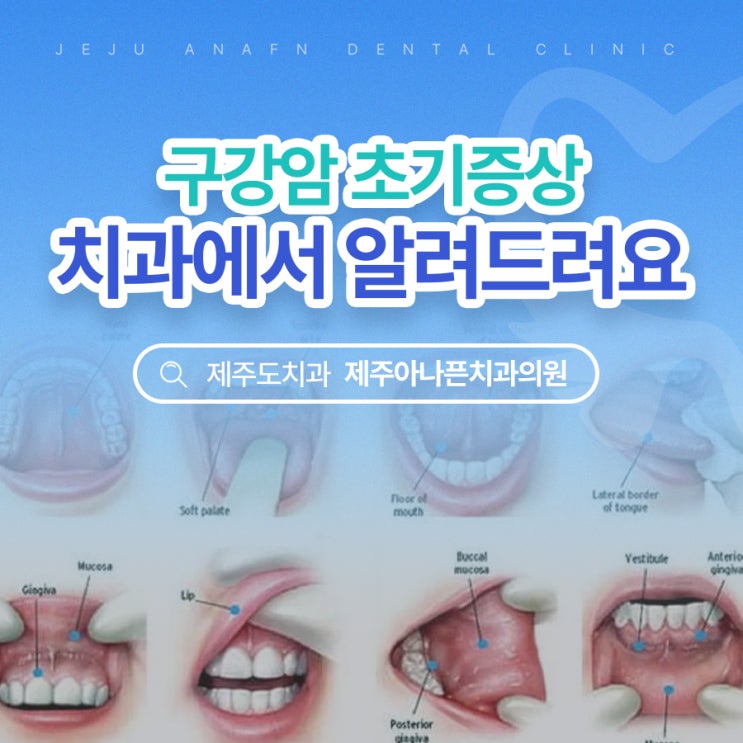  제주연동치과 구내염이 구강암 초기 증상이라고요?