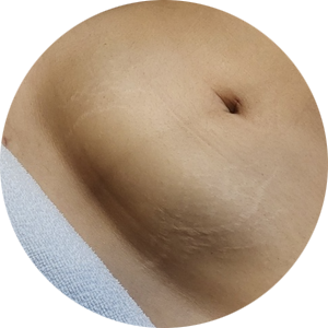  복부 지방흡입 바본 아랫배 바본뭉침이 풀리는 실제 관리 후기