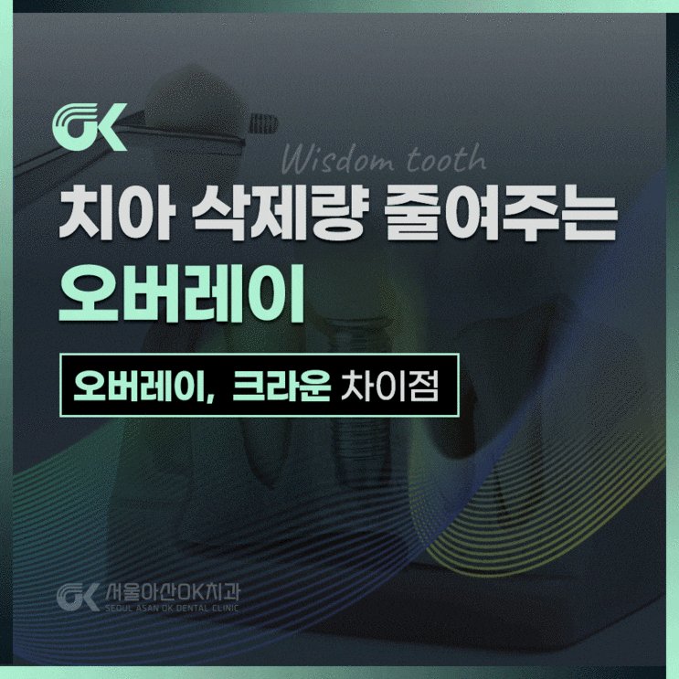  하남시청역치과,  치아 삭제량을 줄여주는 오버레이란?