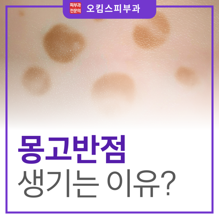  일산 마두동 피부과 몽고반점 생기는 이유, 대체 뭘까?