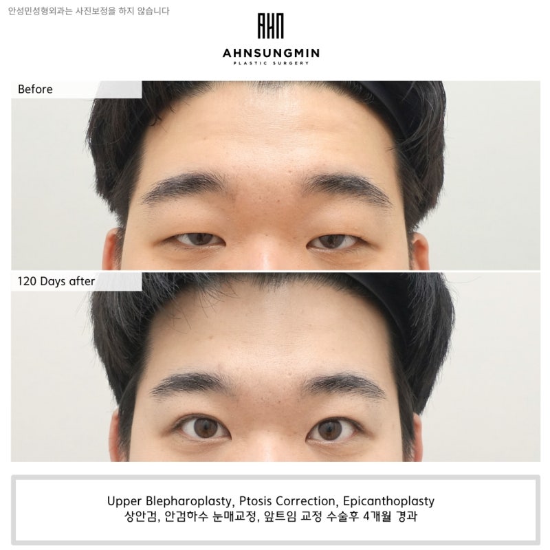 [4개월 경과] 남자 안검하수 수술의 핵심 포인트!!
