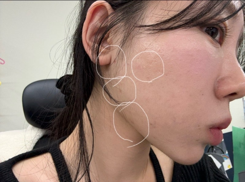 단백질 쉐이크 먹고 여드름? 호르몬성 여드름 원인, 관리 꿀팁 총정리