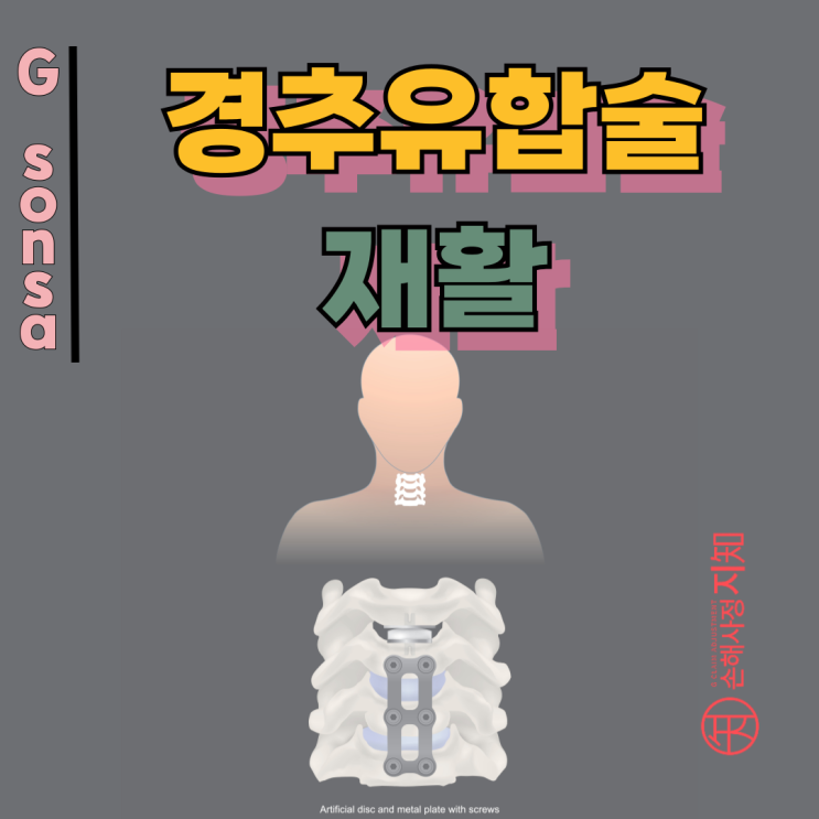  경추유합술 재활, 고정 마디수 보다 중요한 핵심 포인트