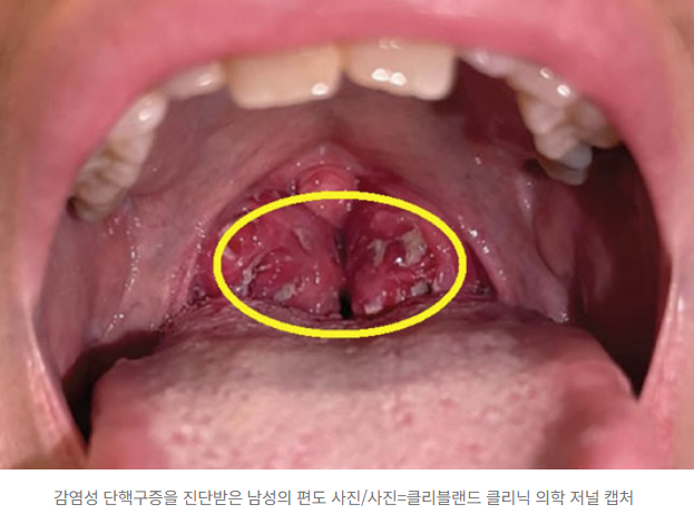  키스 후 편도에 고름까지…36세 남성이 겪은 ‘키스병’의 정체