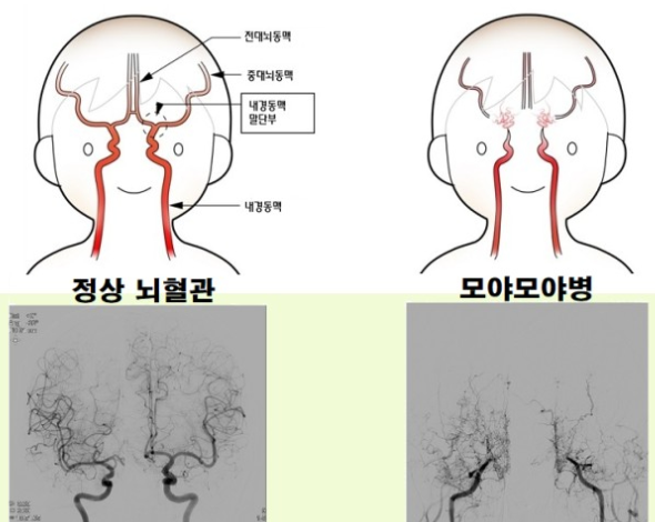 모야모야병(증상·원인·유전·수술·뇌출혈) 총정리 완치 가능할까?