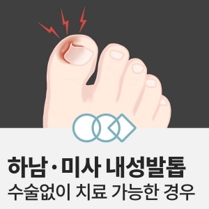 하남 내성발톱, 수술 없이 치료 가능한 경우는?