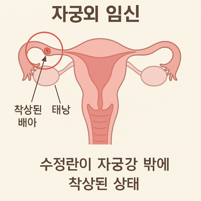 실손보험 자궁외임신 문제: 질병코드와 보험금 청구 사례 종합