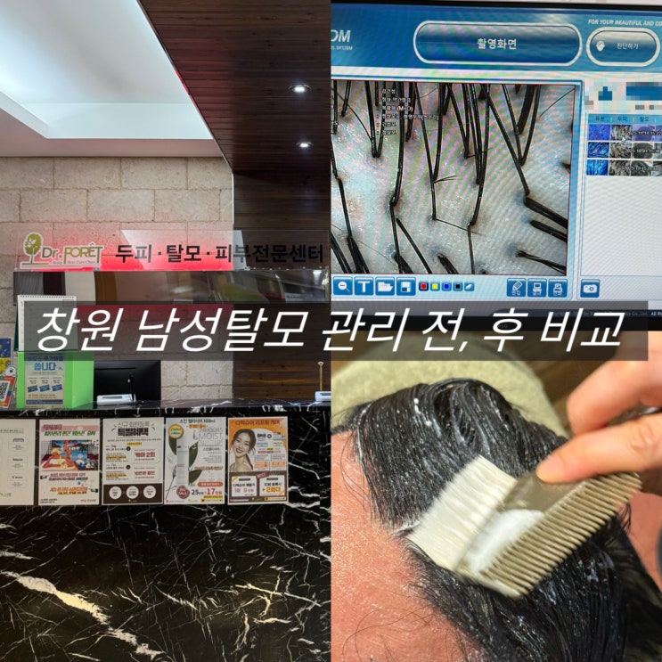  창원 탈모관리 닥터포레 2회차 후기 남성 두피관리 변화