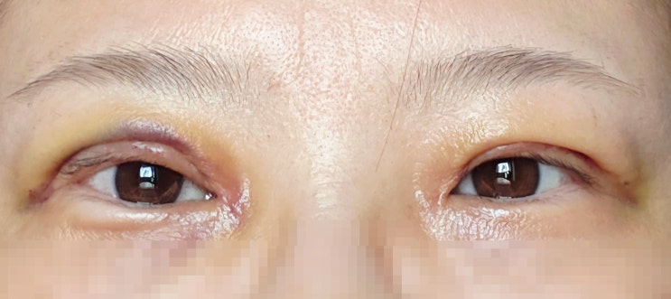  내돈내산 : 25년 만의 절개쌍꺼풀 재수술+눈매교정+미간보톡스  수술당일부터 실밥 풀기까지 리얼 변화 기록^^
