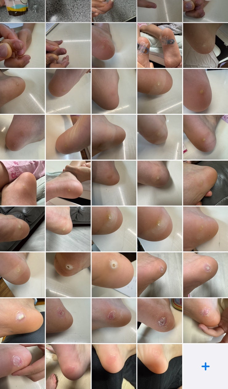 어린이 발바닥 티눈 율무가루와 티눈액, 티눈밴드 교차사용으로 해결