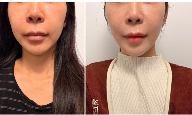  강남역피부과 울쎄라 티타늄리프팅 효과 울타늄 열흘차