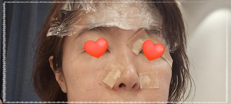 김포 비립종 제거 비용 후기｜사우동 아가파의원 70개 제거 가격 정리