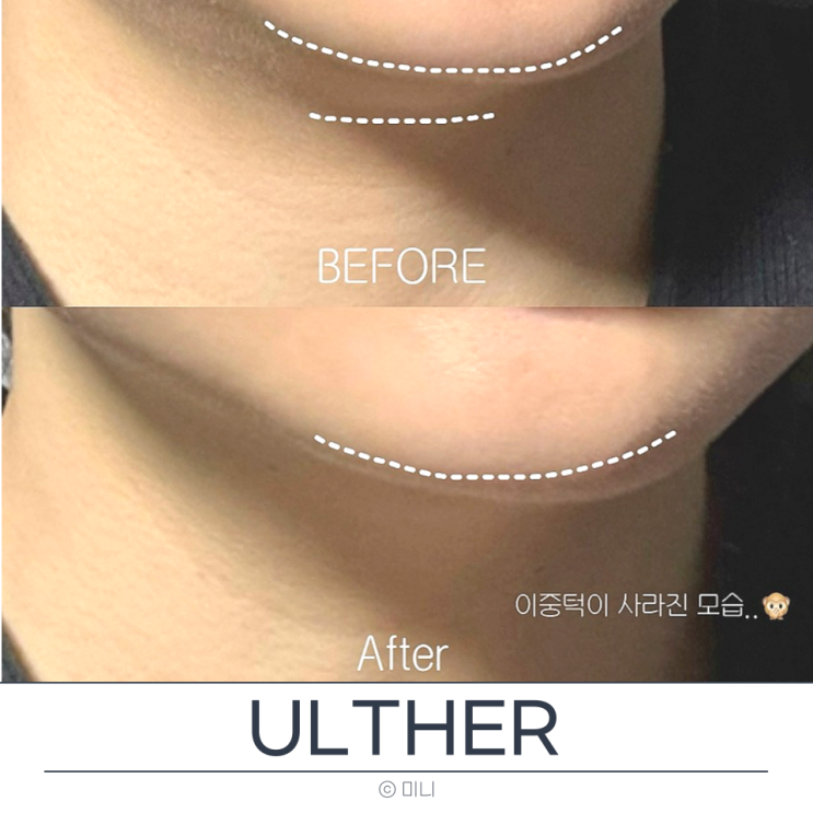  홍대피부과 울쎄라프라임 이중턱리프팅 전후 비교