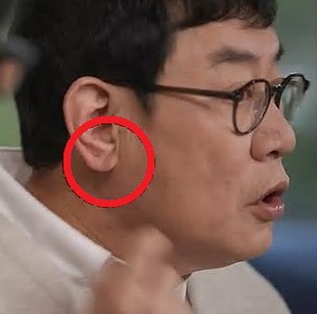  프랭크사인 귓불주름 정말 뇌졸중과 연관 있을까