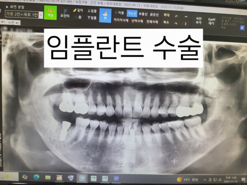 [임플란트 3탄] 드디어 수술! 뼈이식까지 한 번에.. (수술시간, 비용, 고통 리얼후기)