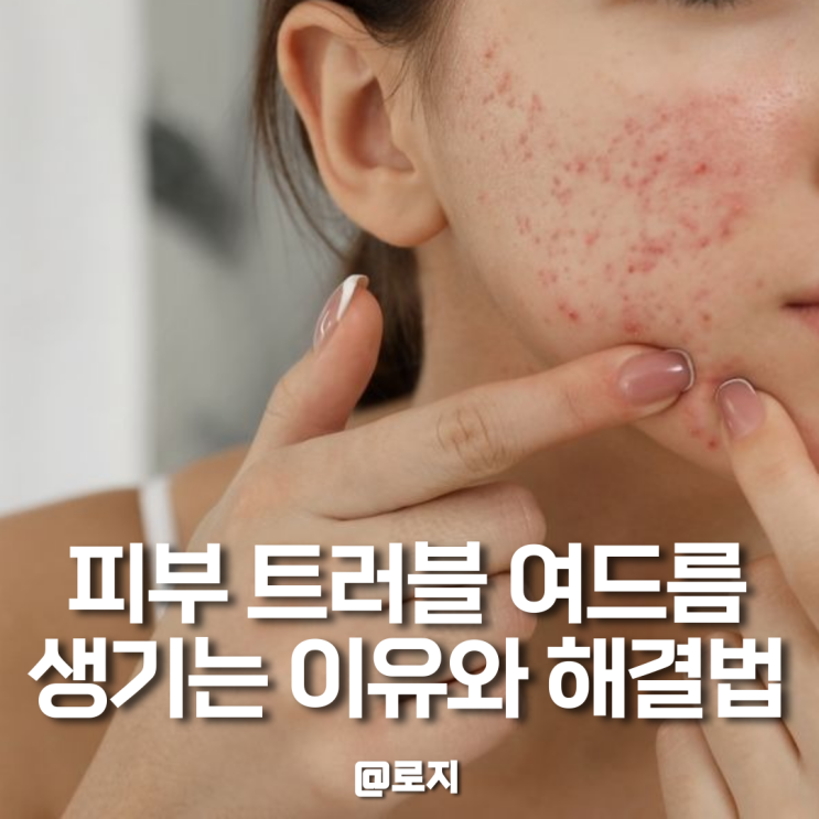  피부 트러블 여드름 원인 이유 5가지 해결 방법