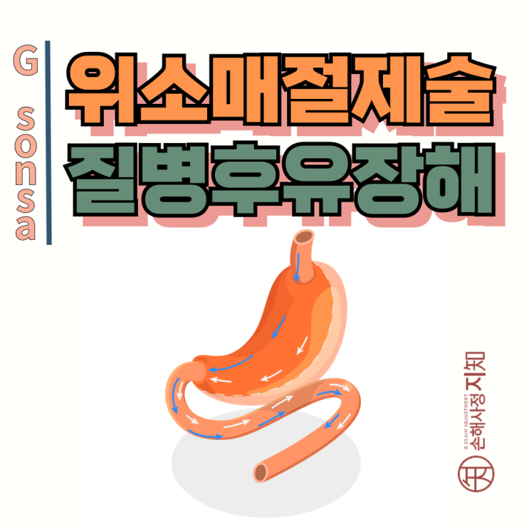  위소매절제술 후 질병후유장해 보험금? 보험사 거절 논리 깨는 비법