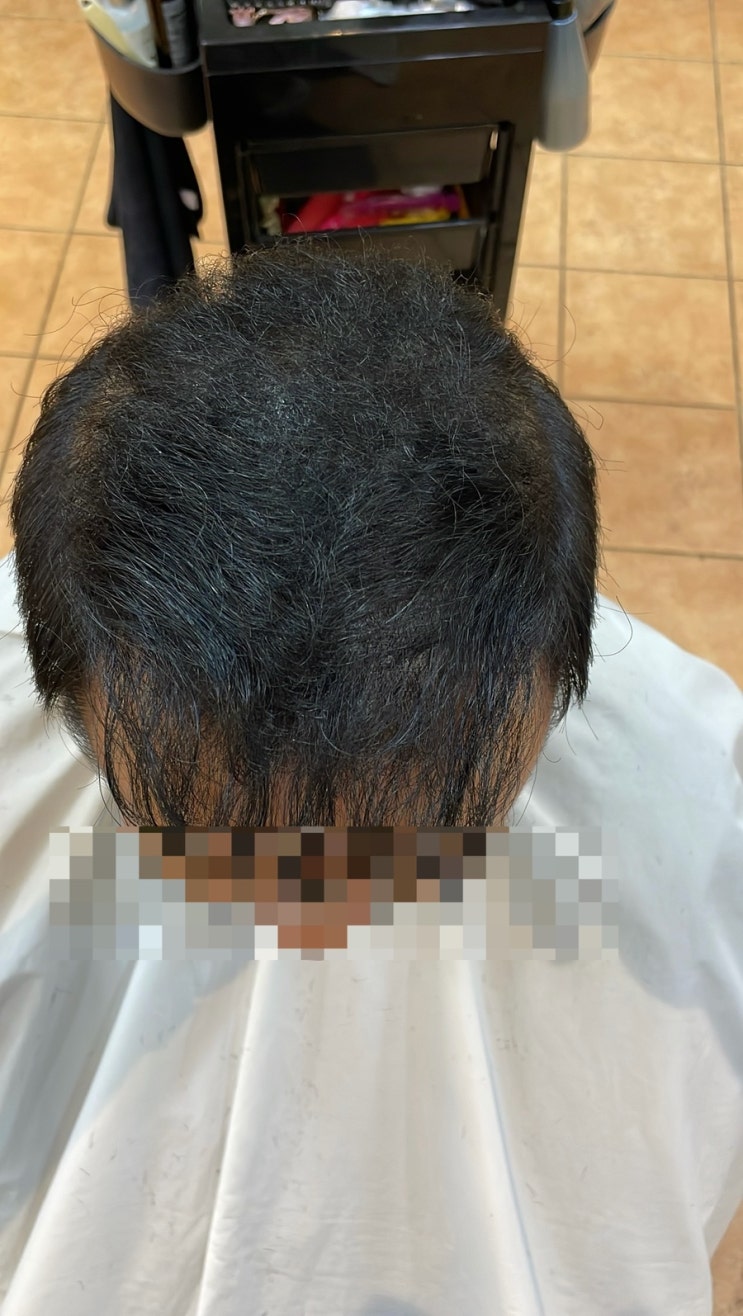  놀라운 결과 공개! 2022년부터 꾸준히 관리한 두피와 모발 헤어스타일 탈모솔루션, 총체적 탈모 고민 해결!