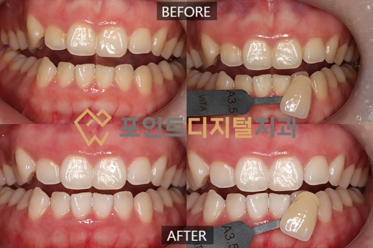  [탕정치과]  오스템 뷰티스 원데이 치아미백 케이스 / 천안 아산 불당 배방