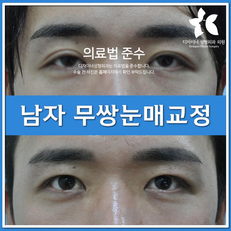 남자 무쌍눈매교정 후기와 안검하수 교정, 눈매교정술 가격으로 눈성형잘하는곳 찾기