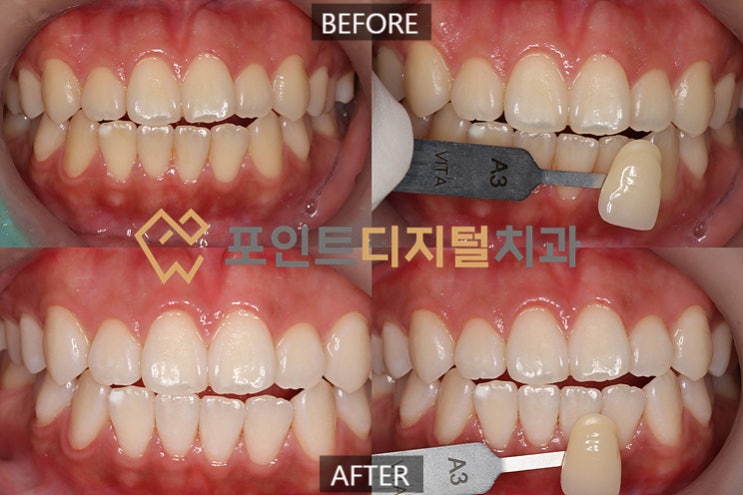  [탕정치과]  오스템 뷰티스 전문가 치아미백(미백폭발 코스 : 각 단계별 변화모습) / 천안 아산 불당 배방