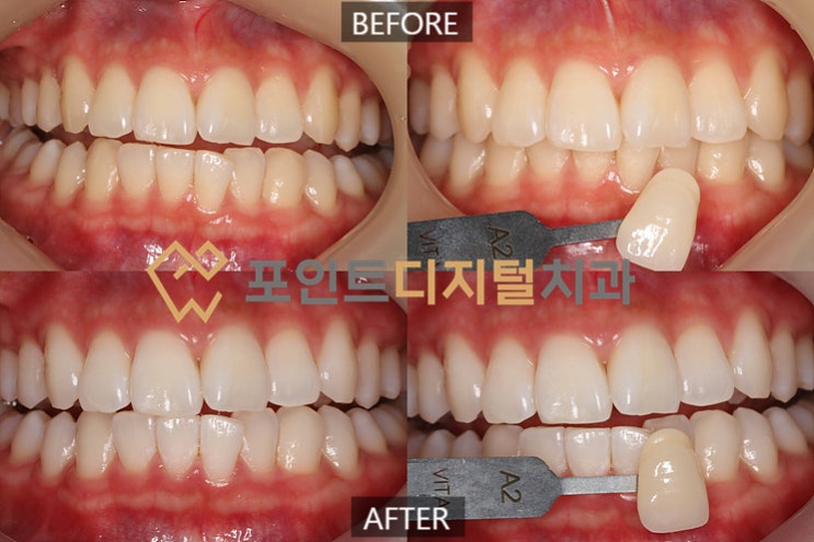 [탕정치과]  오스템 뷰티스 전문가 치아미백(미백폭발 코스) / 천안 아산 불당 배방
