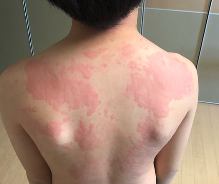  조개구이 먹고 입원? 조개 효능 알레르기 알아봐요