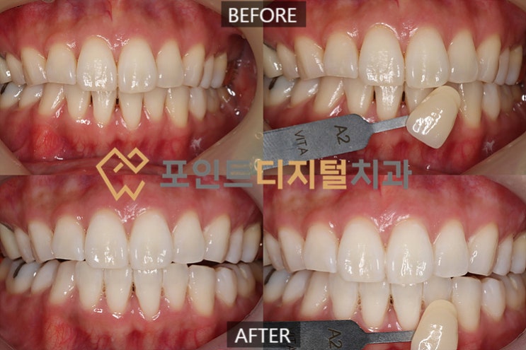  [탕정치과]  오스템 뷰티스 전문가 치아미백(미백폭발 코스) / 천안 아산 불당 배방