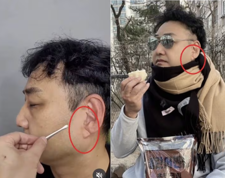 <b>김수용</b> 급성 심근경생 후 <b>회복</b> 중 혹시 귓볼 사선 주름 때문에?... 