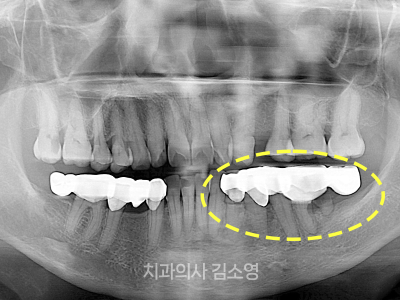 치아 브릿지 수명, 통증 생기면 어떻게 해야 할까?