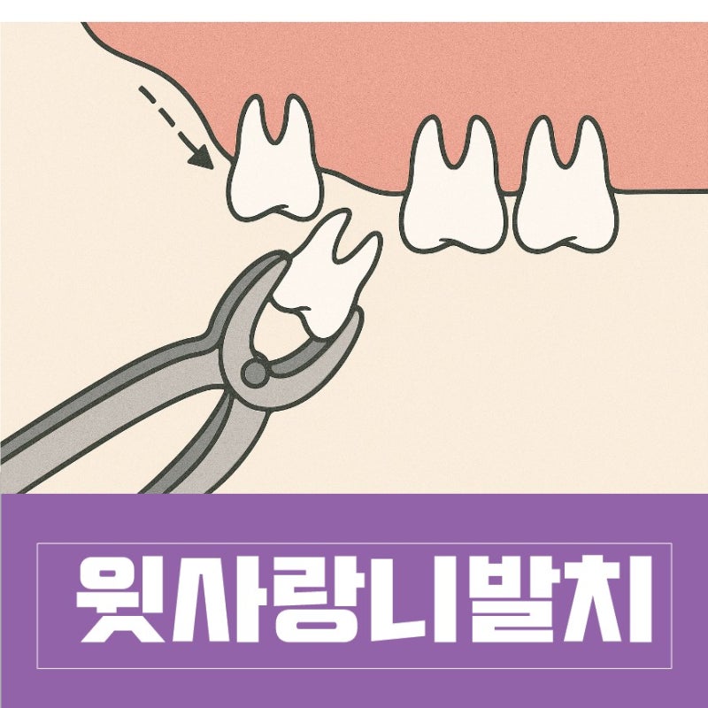 윗사랑니 발치 후기｜통증·회복·구멍 관리까지 한 번에 정리