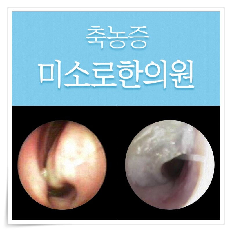 부산축농증한의원 반복되는 기침은 서면에서
