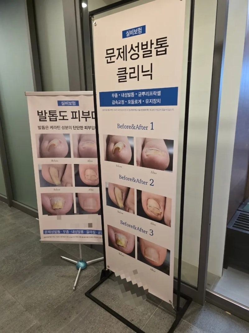 인천송도 발톱무좀 치료하러 유명한 문제성발톱병원 다녀온 후기