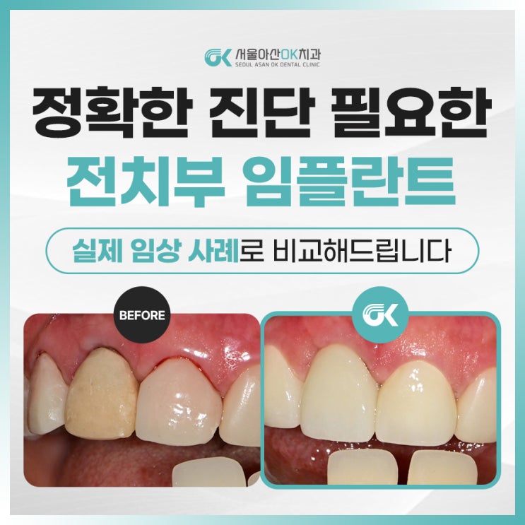  미사양심치과, 전치부 발치 즉시 임플란트 고려 사항은?