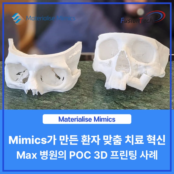  [Materialise S/W] Max 병원의 Point-of-Care 3D 프린팅 : Mimics가 만든 환자 맞춤 치료 혁신