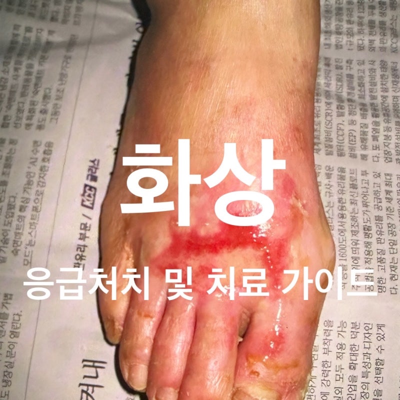 대구 화상치료 피부과 화상 응급처치, 치료, 상처관리까지 칠곡 장재원피부과 의원